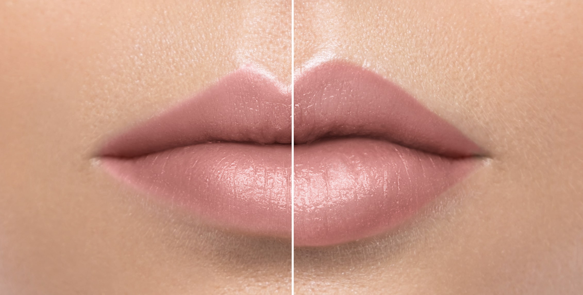 Lip Enhancement - Before & After
