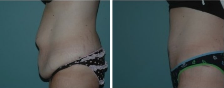 Tummy Tuck before & after