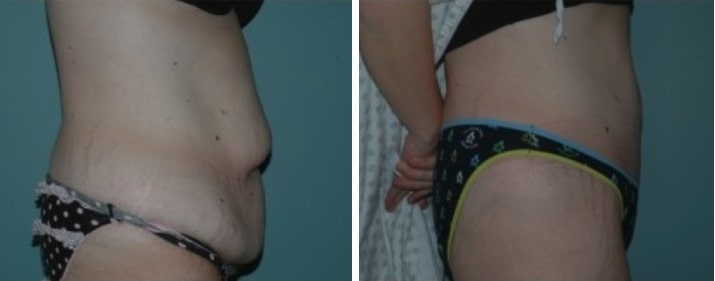 Tummy Tuck before & after