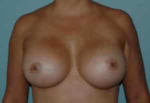 Breast Augmentation