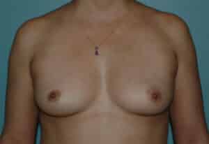 Breast Augmentation