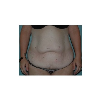 Abdominoplasty