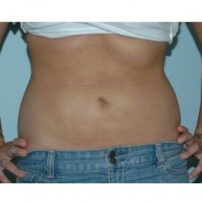 Liposuction