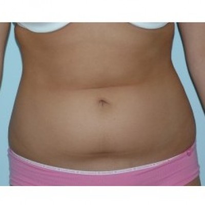 Liposuction