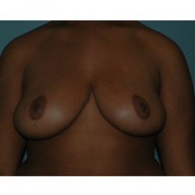 Breast Reduction