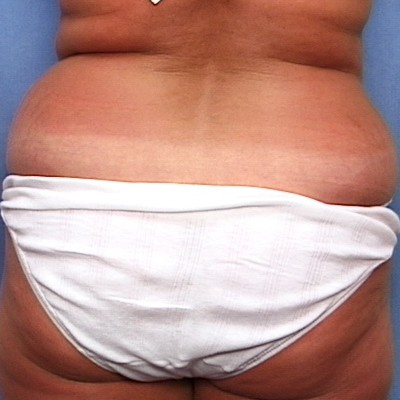 Liposuction