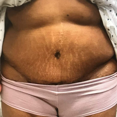 Abdominoplasty