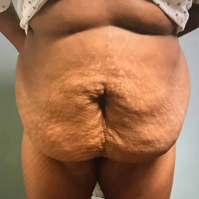 Abdominoplasty